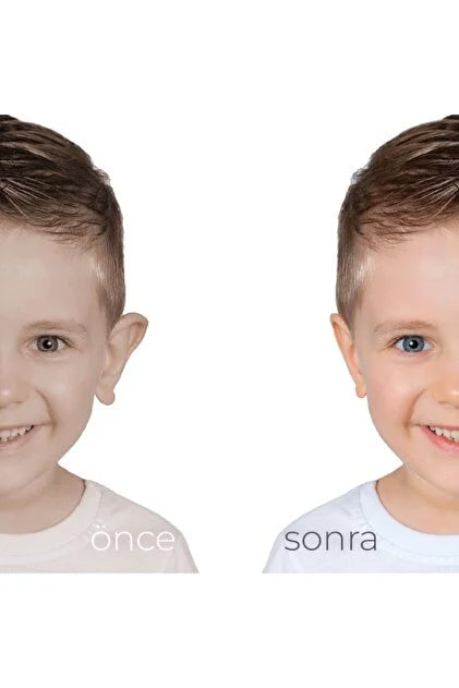 Kepçe Kulak Düzeltici ve Önleyici Bant Kozmetik Bandı 1 Alana 1 Bedava